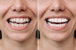 before and after photo of a person with veneers
